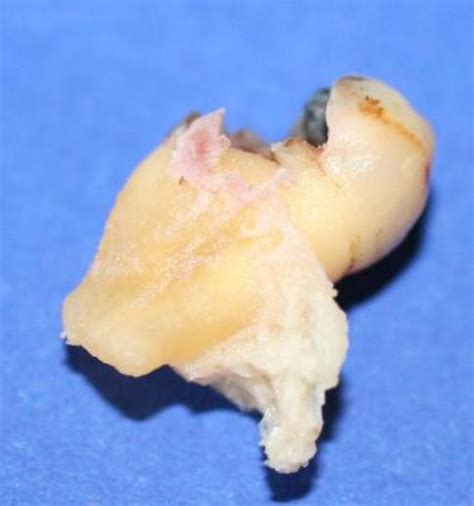 fractured maxillary tuberosity exodontia