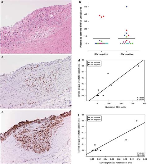 Atherosclerotic Plaque Character A Thoracic Aorta Siv Negative