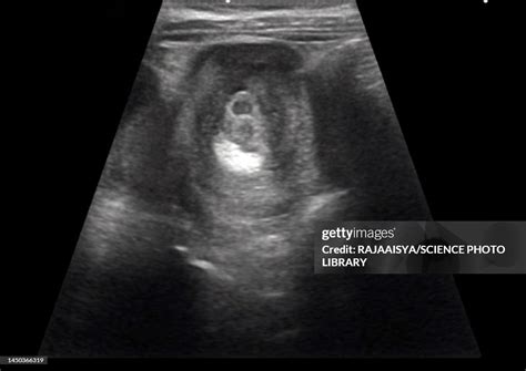 Intussusception Of The Intestines Ultrasound Scan Foto De Stock Getty