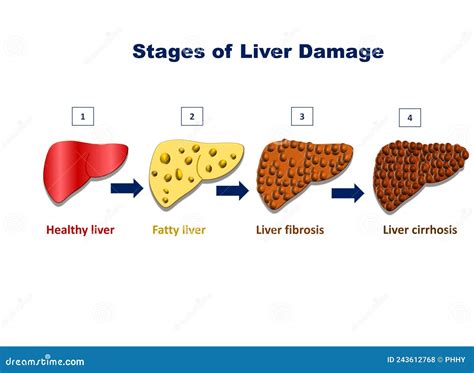 Stages Of Liver Damage Liver Injury Fatty Liver Liver Fibrosis Liver