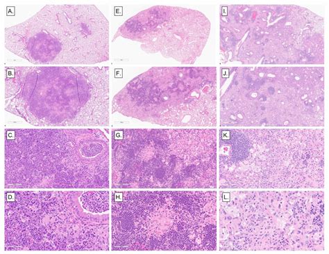 Tuberculosis Lungs Histology