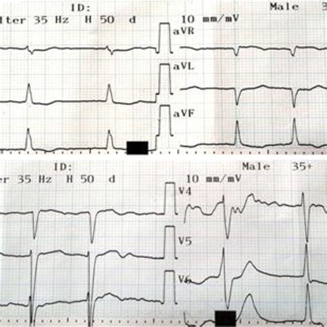 An Electrocardiography Performed Concurrent With The Patient S Symptoms