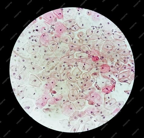 Premium Photo Microscopic View Of Trichomonas Vaginalis In Pap Smear With Acute Inflammatory Cells