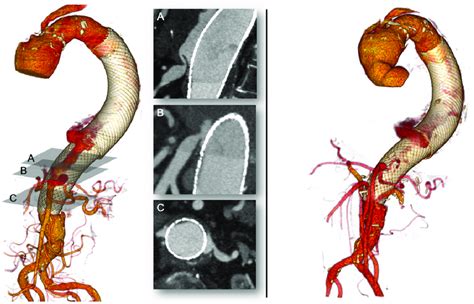 Preoperative Computed Tomography Angiography Left Side Of A Female