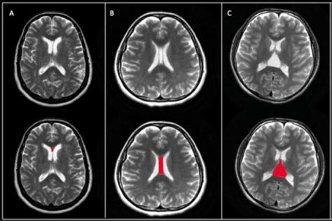 Septum Pellucidum Mri