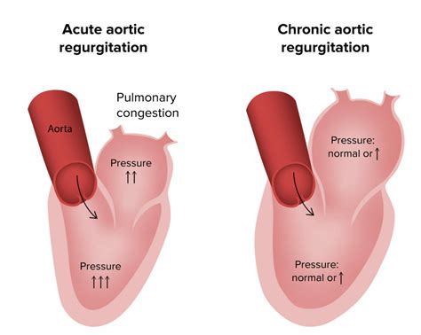 Regurgitação Aórtica Concise Medical Knowledge