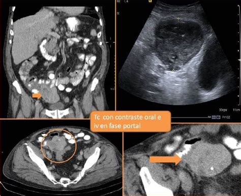 TUMORES DEL ESTROMA GASTROINTESTINAL CARACTERÍSTICAS RADIOLÓGICAS Y