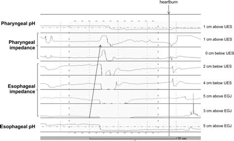 Normal Values Of Pharyngeal And Esophageal Hour Ph Impedance In