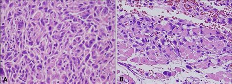 Pleomorphic Dermal Sarcoma A High Power View Reveals Frequent