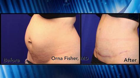 Dr Orna Fisher Discusses Abdominoplasty Tummy Tuck Youtube