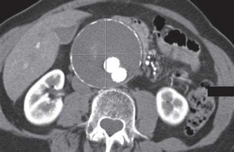 Abdominal Aortic Aneurysms Revisited MDCT With Multiplanar