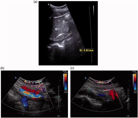 Inferior vena cava ultrasound after 2 years of follow-up shows good ...