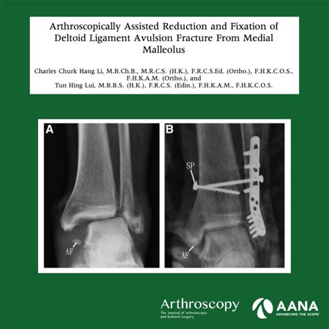 Trauma Y Ortopedia M Xico Reducci N Asistida Por Artroscopia Y