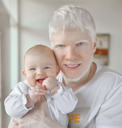 Miracle child: what the baby from a model and the most beautiful albino ...