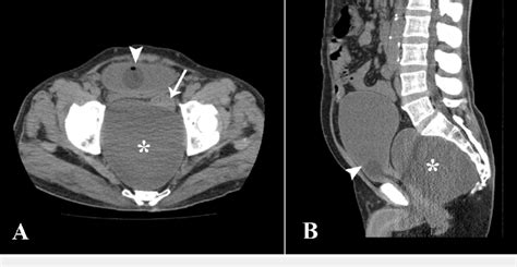 Axial A And Sagittal B Sections From Ct Kub Download Scientific