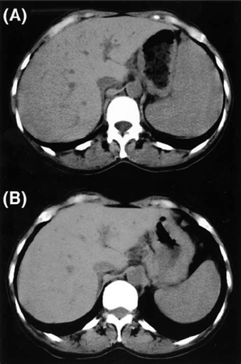 Abdominal Computed Tomography Scans At The Time Of Diag Download