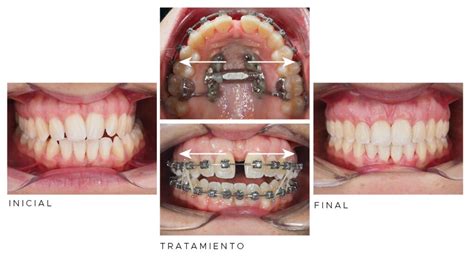Marpe Todo Lo Que Debes Saber Sobre Este Disyuntor Ortodoncia Madrid