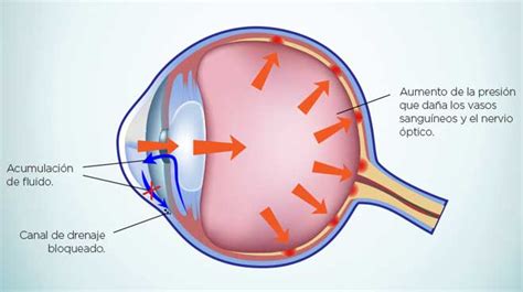 El Glaucoma Grupo Oftalmológico