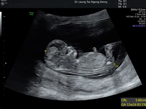 Nuchal translucency ultrasound - HKOG-INFO