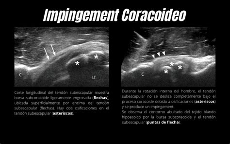 Ecografía dinámica en el hombro Tempo Formación