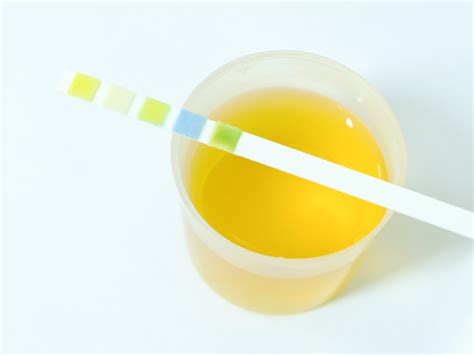 Urine Osmolality Test: Purpose, Procedure, and Results