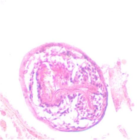 Histopathological Specimen Of Hydatid Cysts The Scolex Contained Download Scientific Diagram