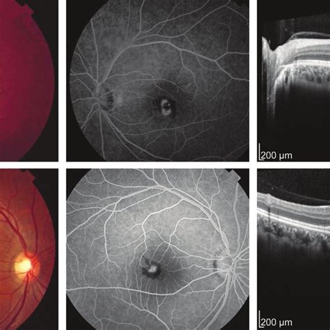 Fundus Photos Ffa And Oct Images Of Two Patients At The Time Of