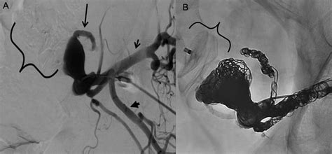 Pre And Post Embolization Fluoroscopic Images Of The Case Endoleak