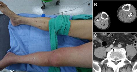 Figure 1 From Surgery For The Venous Disaster Phlegmasia Cerulea