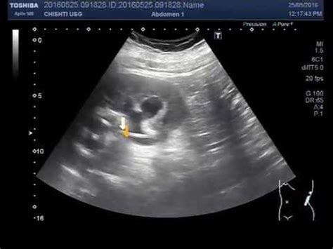 Renal Bladder Ultrasound