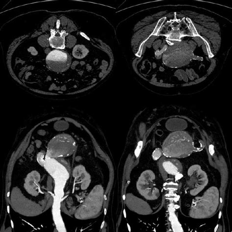 A And B Left Internal Iliac Artery Embolization C And D Iliac