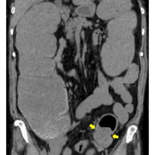 Computed Tomography Scans Obtained After And Before Colonic Stenting A