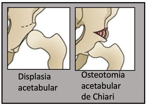 Displasia Do Quadril Medicina De Excel Ncia