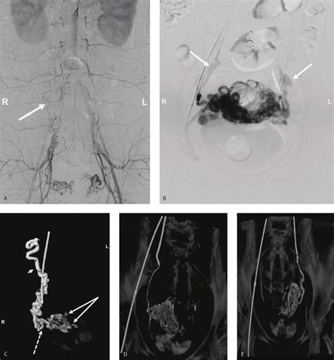 Case 2 A Pre Embolization Flush Pelvic Arteriogram Demonstrating