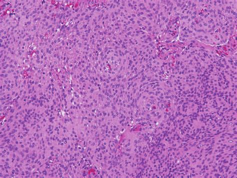 Histological Examination Of First Operation Hematoxylin Eosin Stain