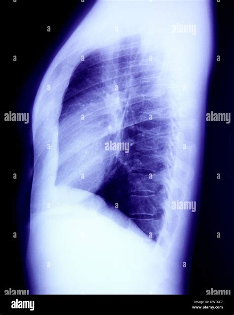 Thorax x ray Stock Photo - Alamy