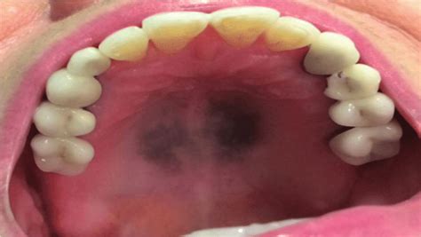Clinical aspect of hyperpigmentation of hard palate induced by... | Download Scientific Diagram
