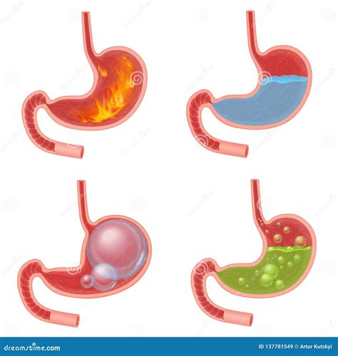 Acid Reflux Disease Symptoms Or Heartburn Royalty-Free Stock