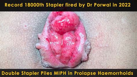 Record 18000th Stapler Fired By Dr Porwal In 2022 Double Stapler Piles