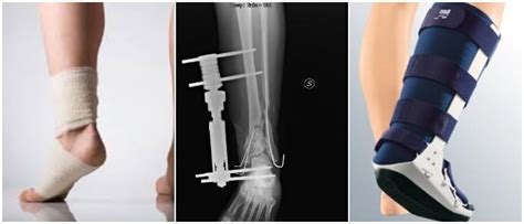 Fractura de Peroné Tipos Causas Síntomas Diagnóstico Tratamiento