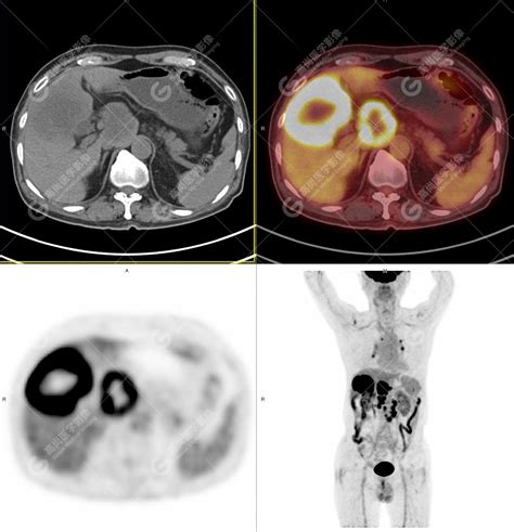 体重骤降6斤，petct诊断胆管癌，一种被低估的恶性肿瘤胆管癌胆管检查肿瘤患者影像 健康界