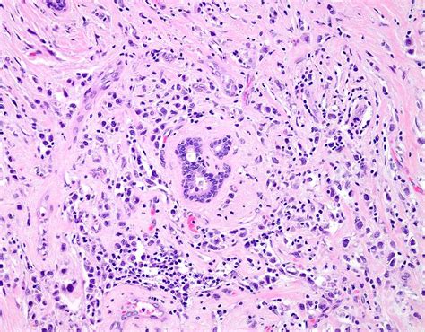 Invasive Lobular Breast Cancer Photograph by Webpathology/science Photo Library