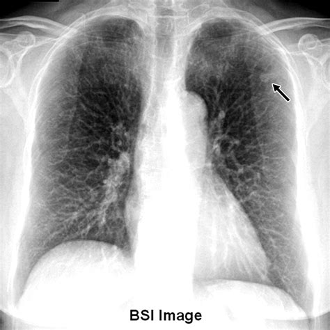 Improved Detection Of Subtle Lung Nodules By Use Of Chest Radiographs