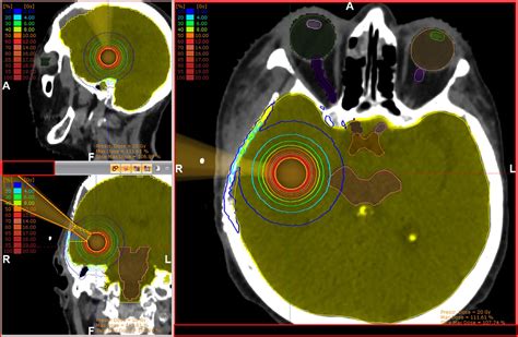 Frontiers Dosimetric Comparison Of Upfront Boosting With Stereotactic