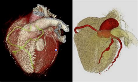 3d Coronary Ct Angiogram Reconstruction Demonstrating Large Lad