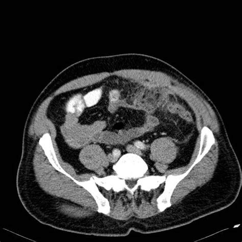 Pin On Radiologie Sist Digestiv