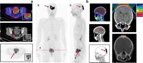 A 58 Year Old Female Patient Presented With Cervical Cancer For Download Scientific Diagram