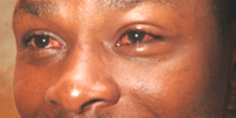 Red Eyes Outbreak Scares Kampala Monitor