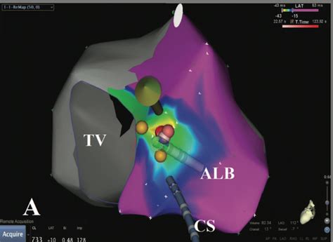 Catheter Ablation Of Focal Atrial Tachycardia Using Remote Magnetic