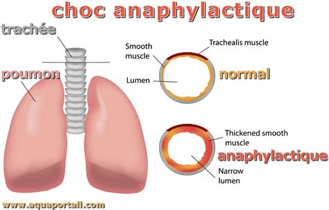 Choc anaphylactique définition et explications